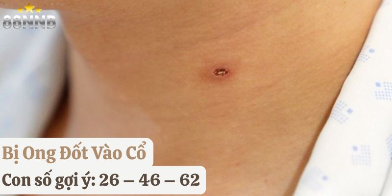 tự nhiên bị ong đốt